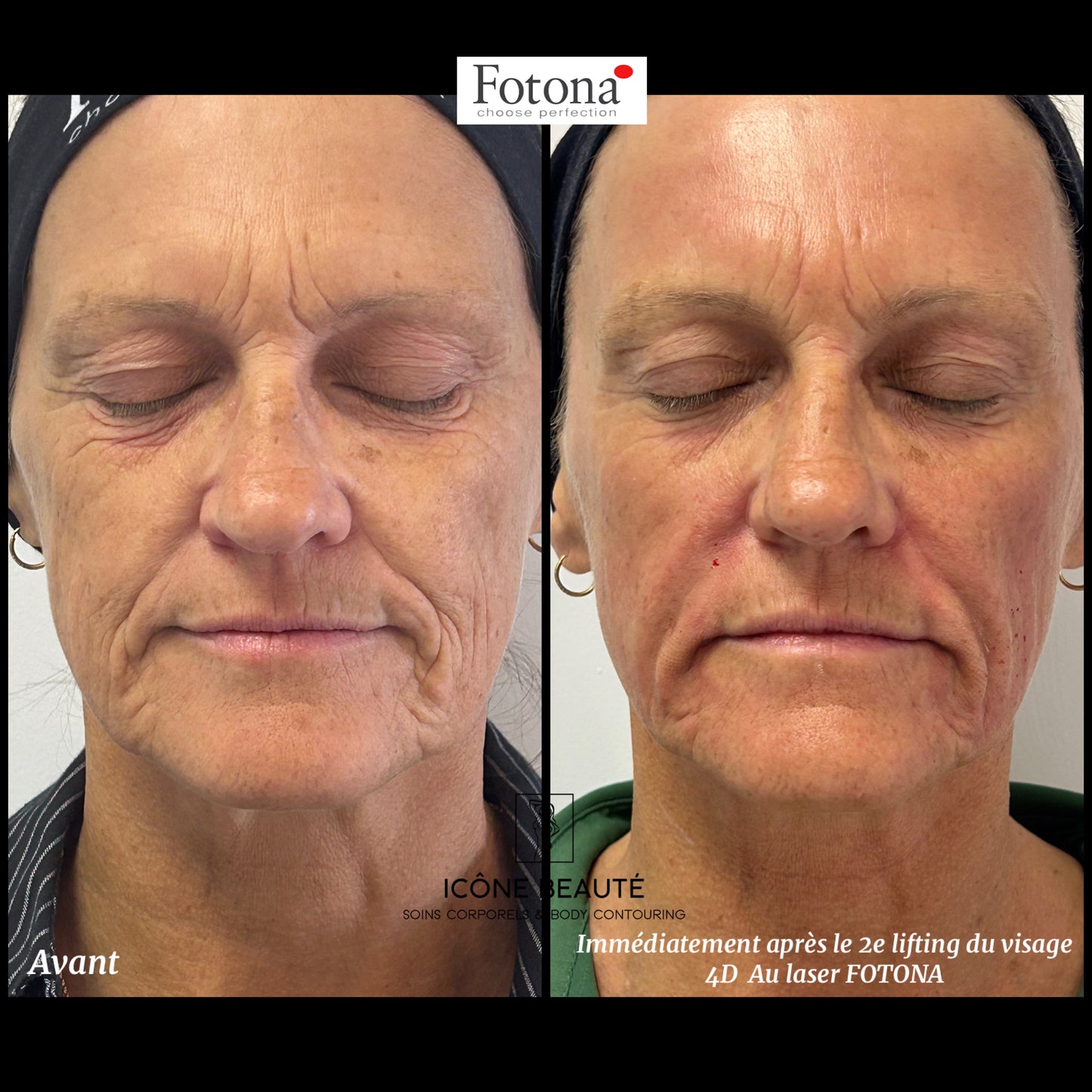 ✨ Skin Tightening Visage Complet – SIGNATURE Icône Beauté - Fotona