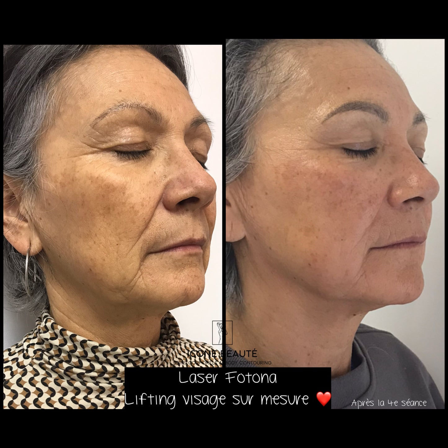 đ FOTONA LASER VISAGE â Non-Ablative Skin Tightening (Visage Complet 3D)