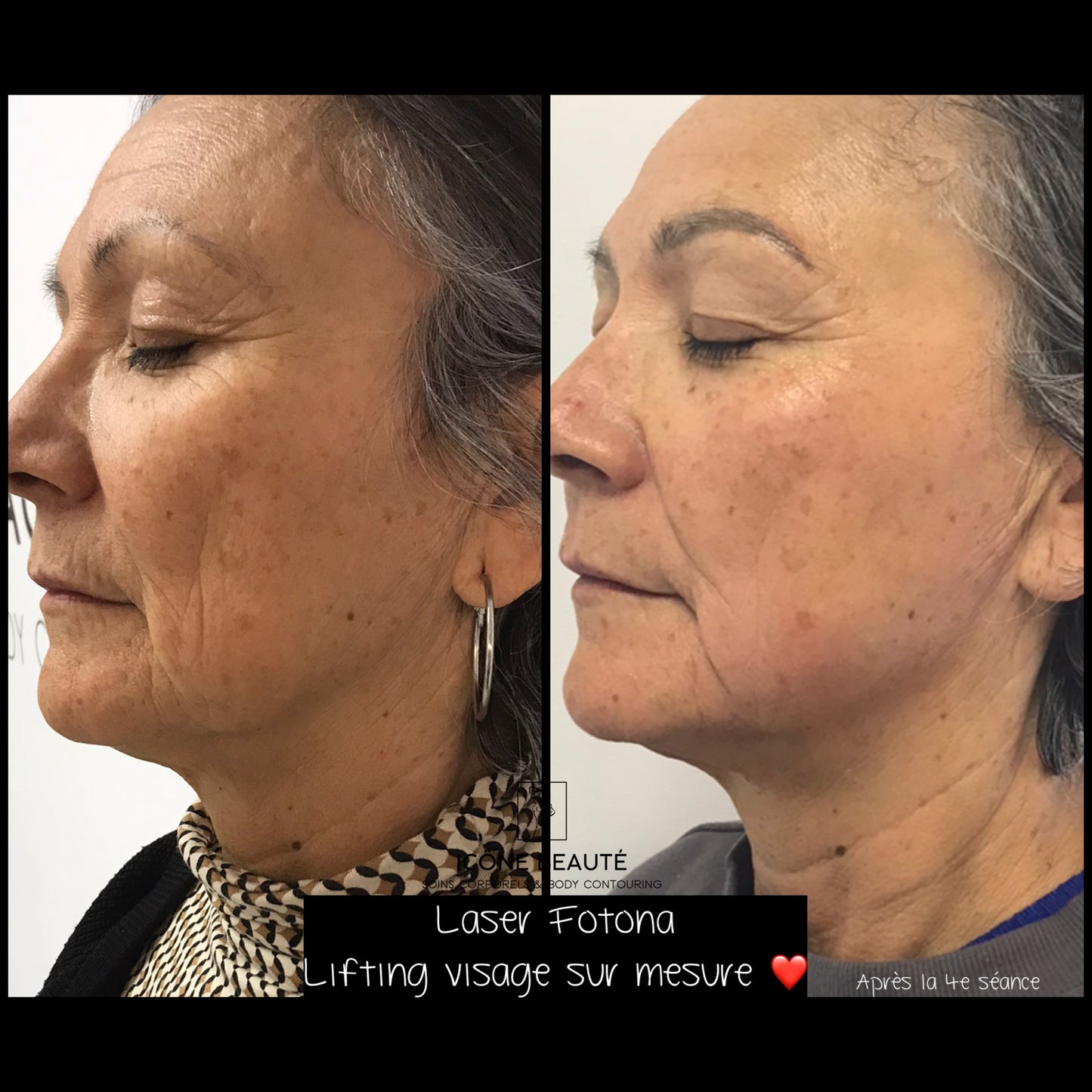 đ FOTONA LASER VISAGE â Non-Ablative Skin Tightening (Visage Complet 3D)
