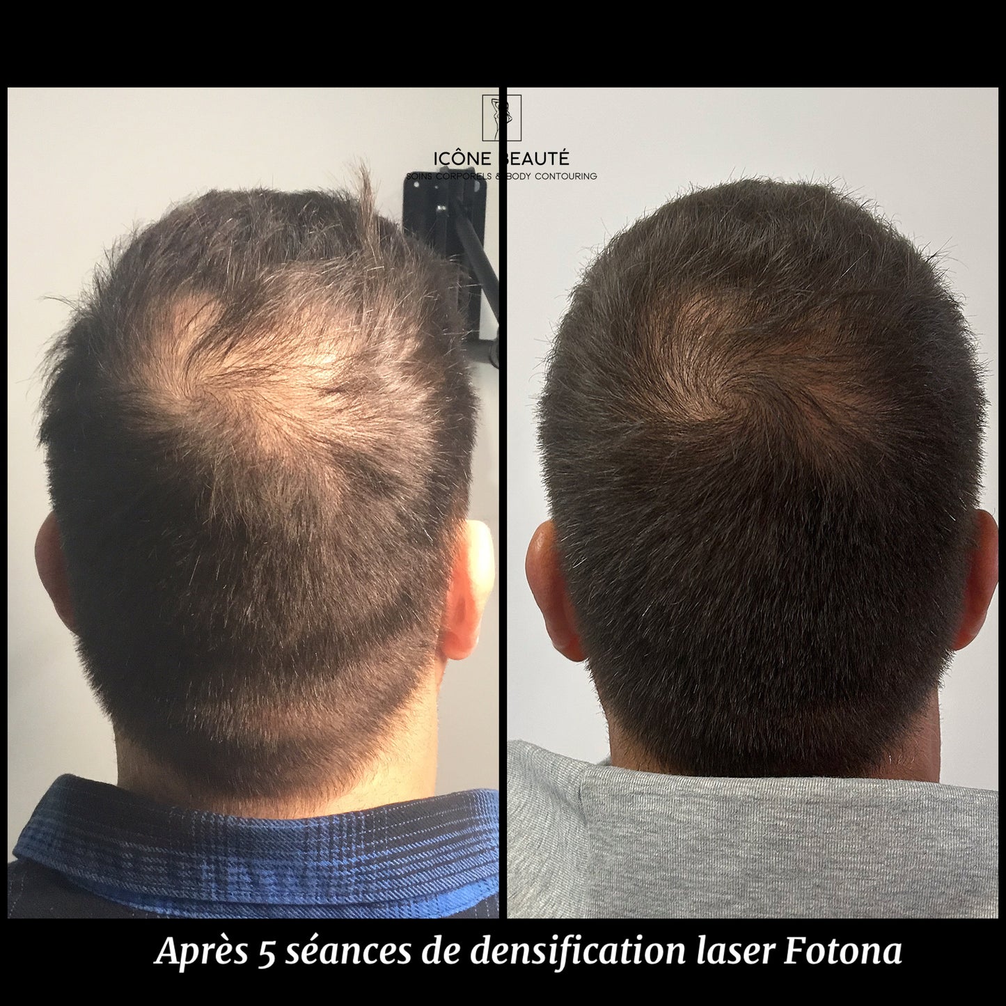 đč DENSIFICATION CAPILLAIRE - Laser Fotona - HairRestartÂź