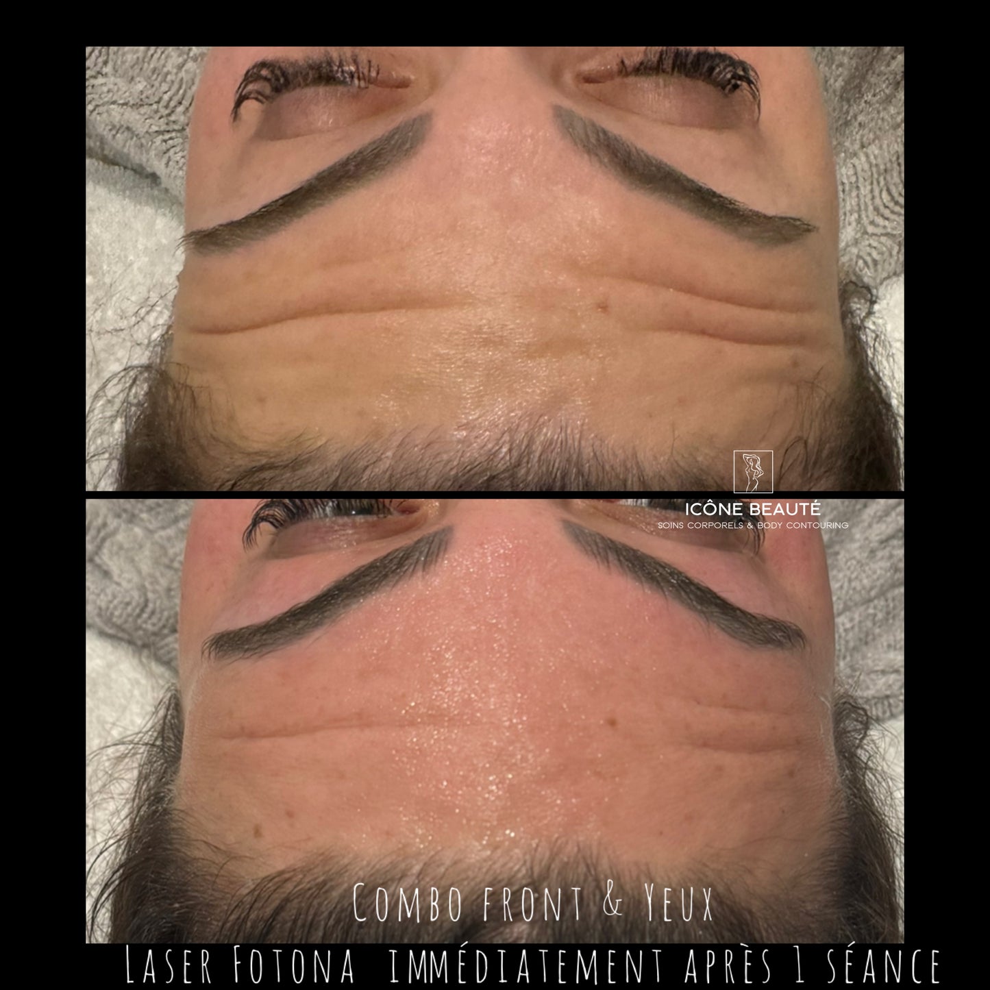 ✨ FOTONA LASER – Combo Smooth Eyes + Rides frontales