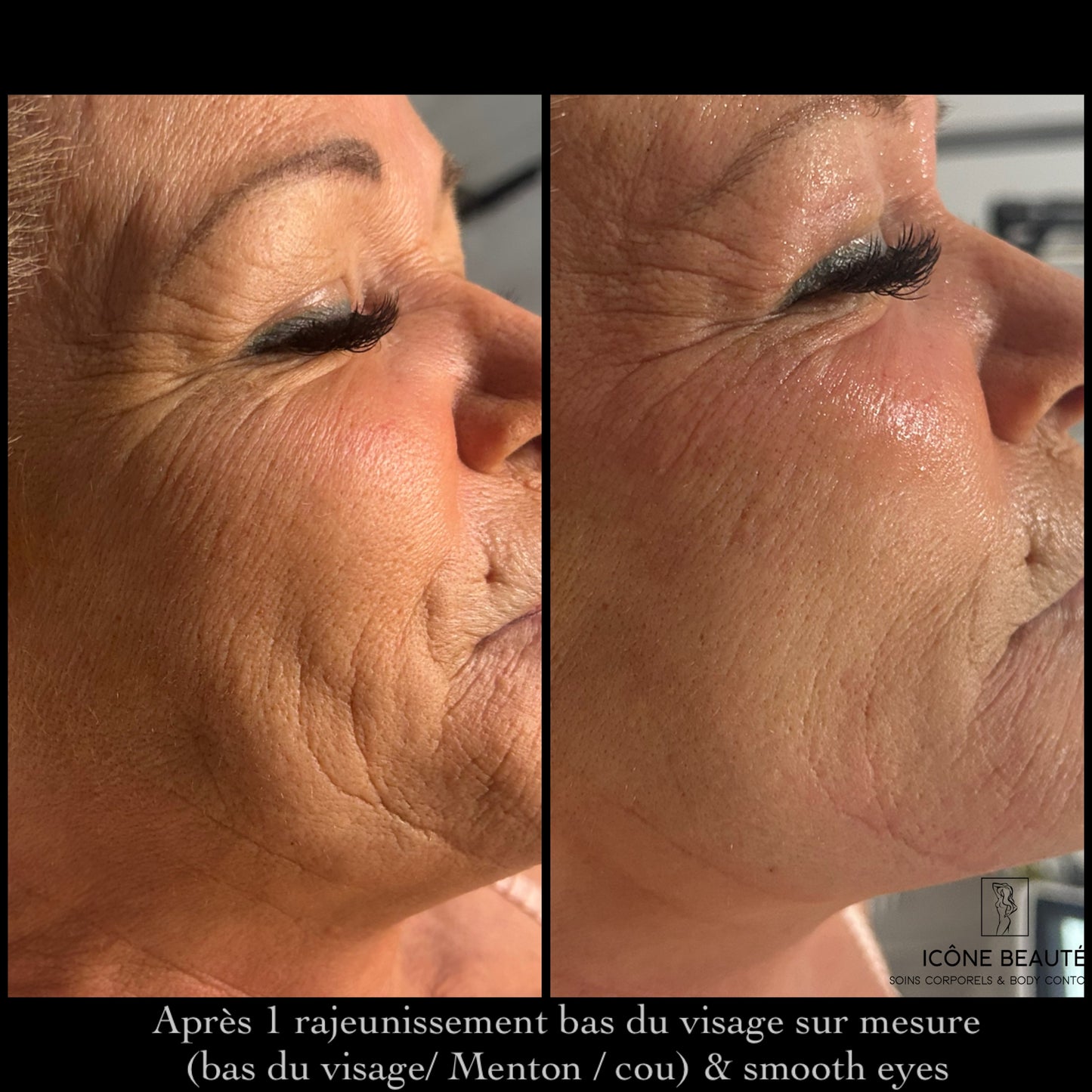 TightSculpting® – Lifting Bas du visage