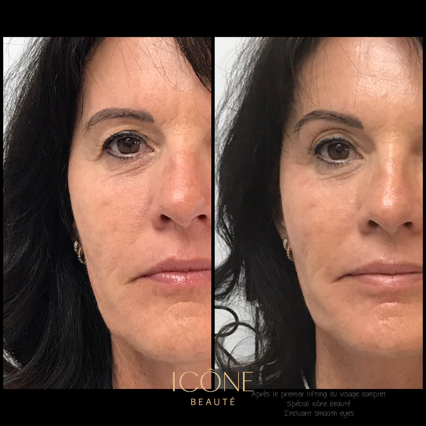 ✨ Skin Tightening Visage Complet – SIGNATURE Icône Beauté - Fotona