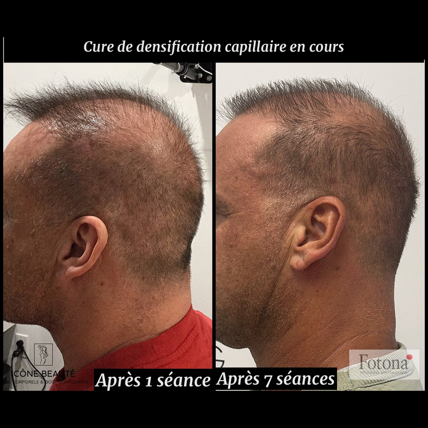 đč DENSIFICATION CAPILLAIRE - Laser Fotona - HairRestartÂź