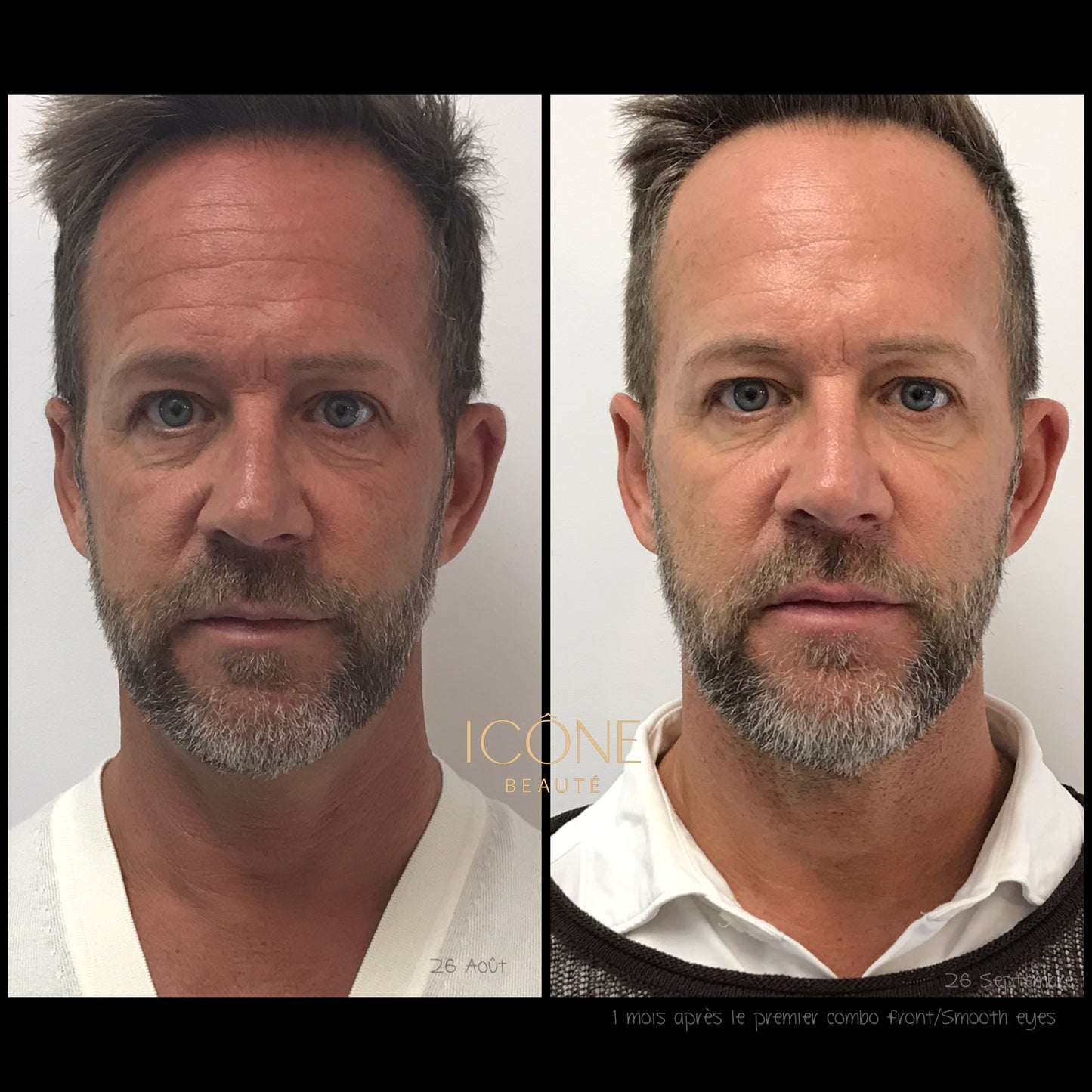 ✨ FOTONA LASER – Combo Smooth Eyes + Rides frontales