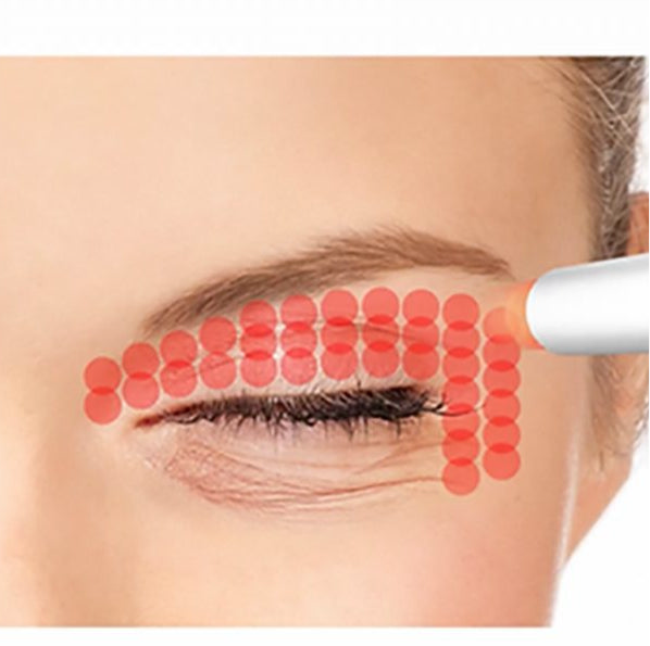 👁️ SmoothEye® – Rajeunissement du regard