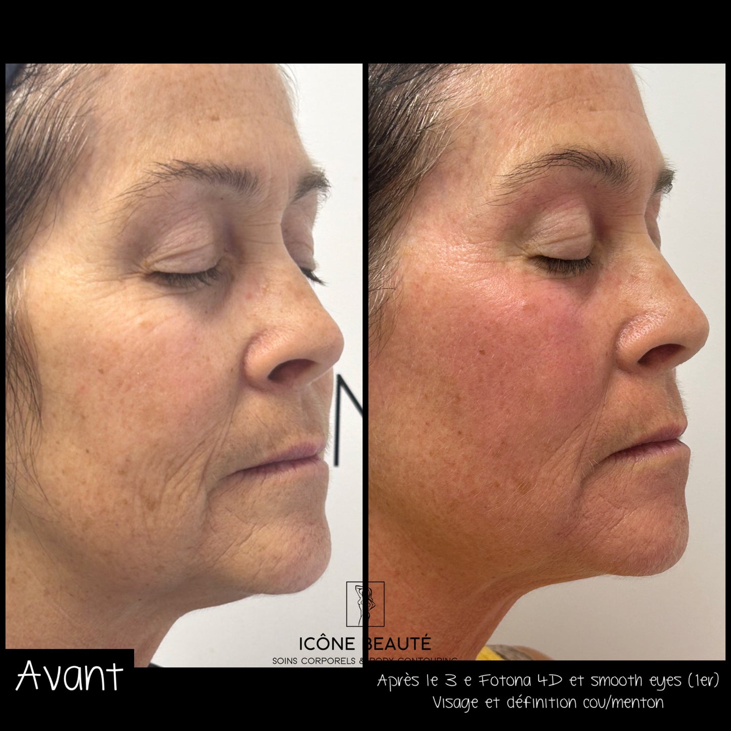 ✨ Skin Tightening Visage Complet – SIGNATURE Icône Beauté - Fotona