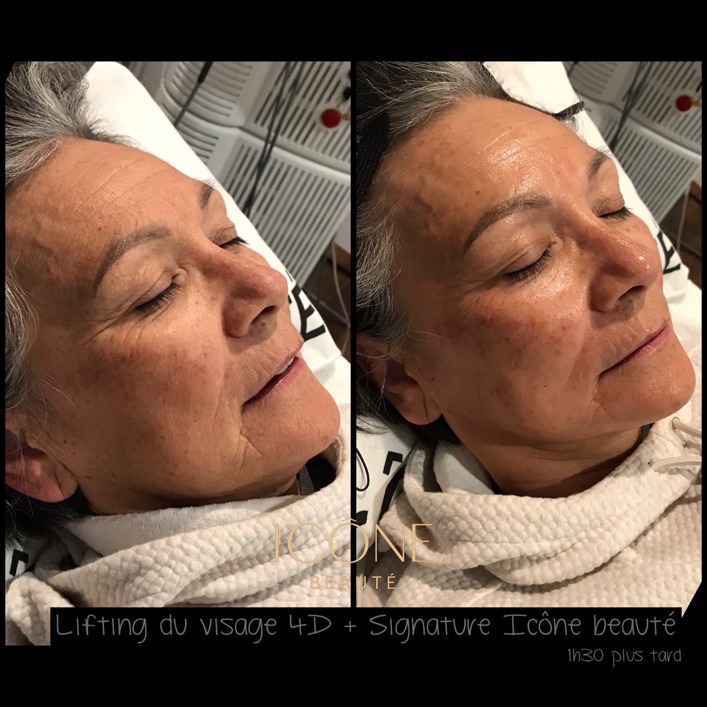 ✨ Skin Tightening Visage Complet – SIGNATURE Icône Beauté - Fotona