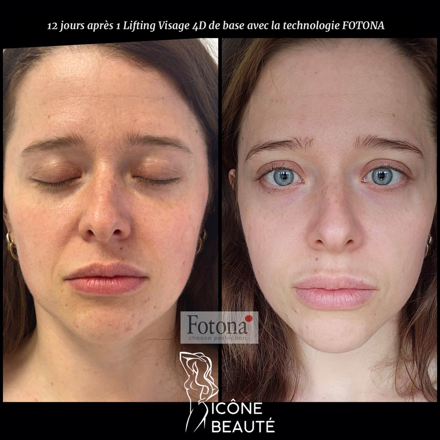 ✨ Skin Tightening Visage Complet – SIGNATURE Icône Beauté - Fotona