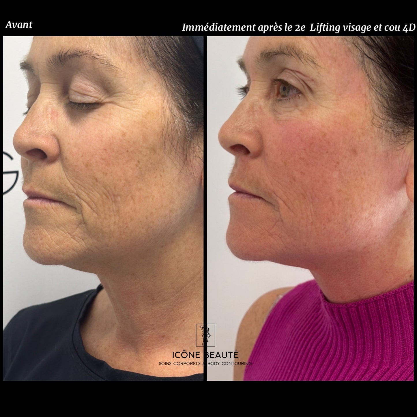 ✨ Skin Tightening Visage Complet – SIGNATURE Icône Beauté - Fotona