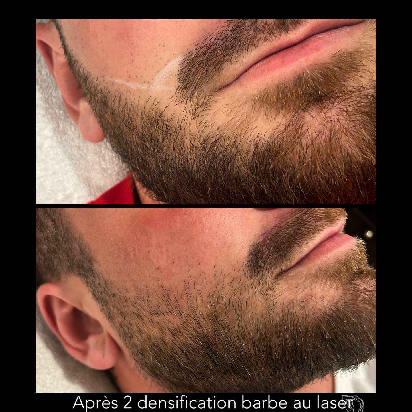 đč DENSIFICATION CAPILLAIRE - Laser Fotona - HairRestartÂź