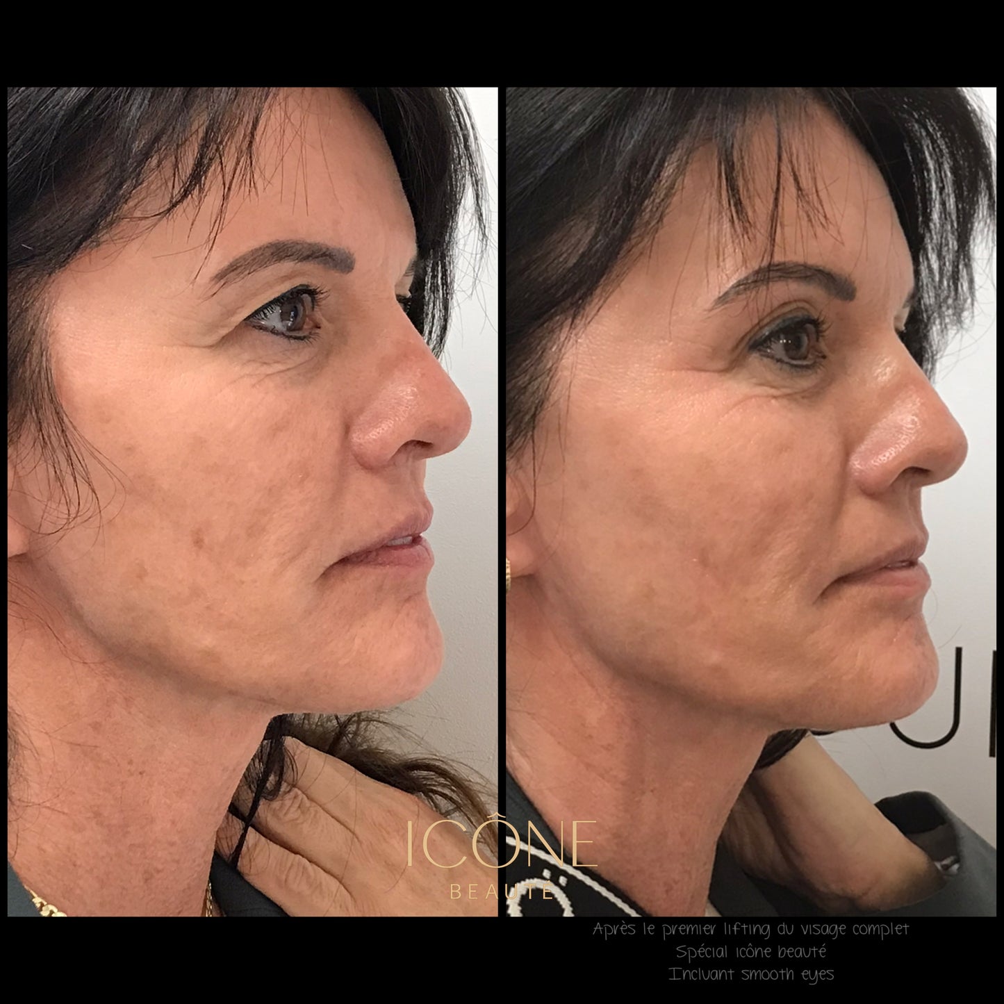 ✨ Skin Tightening Visage Complet – SIGNATURE Icône Beauté - Fotona