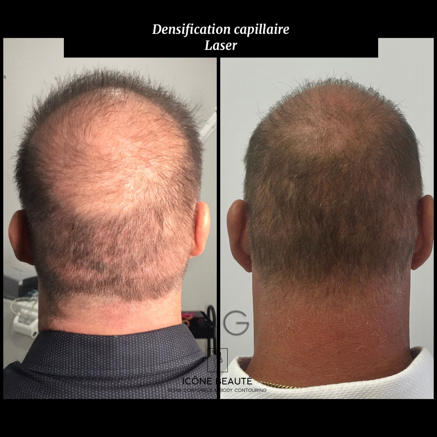 đč DENSIFICATION CAPILLAIRE - Laser Fotona - HairRestartÂź