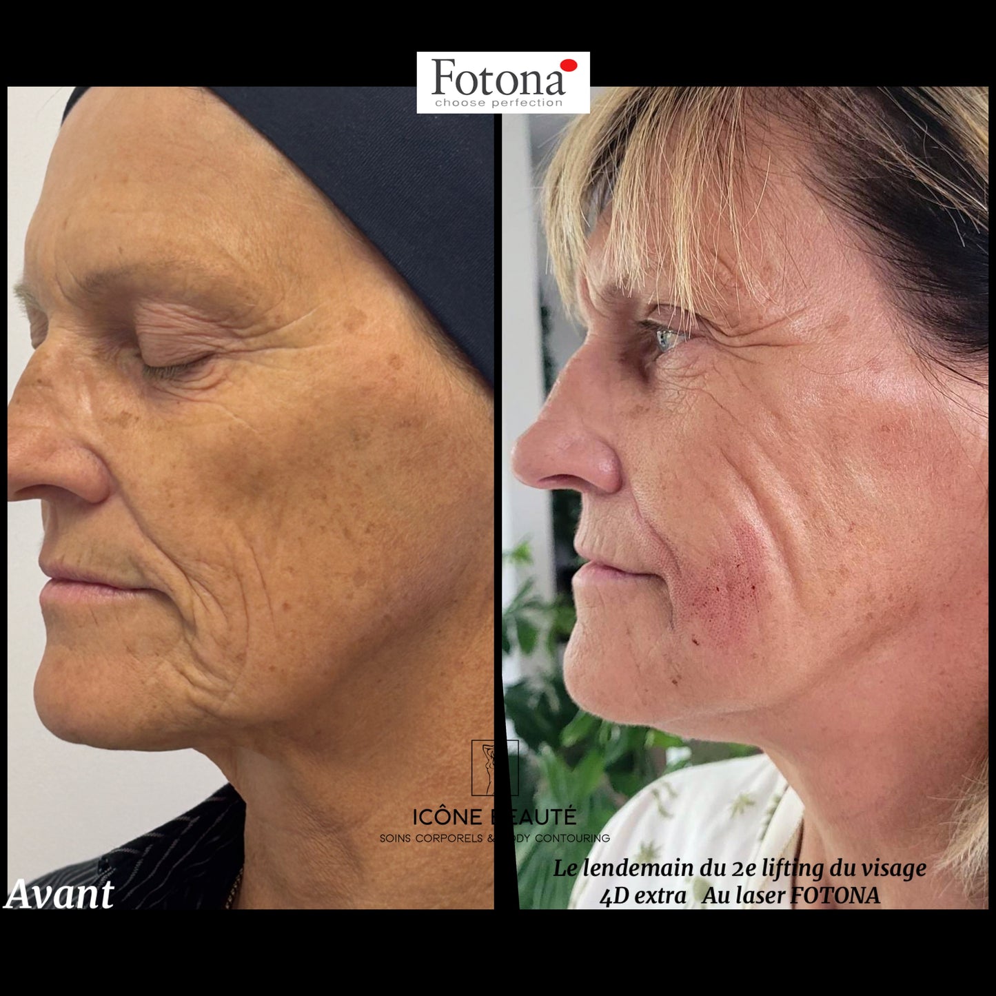 ✨ Skin Tightening Visage Complet – SIGNATURE Icône Beauté - Fotona