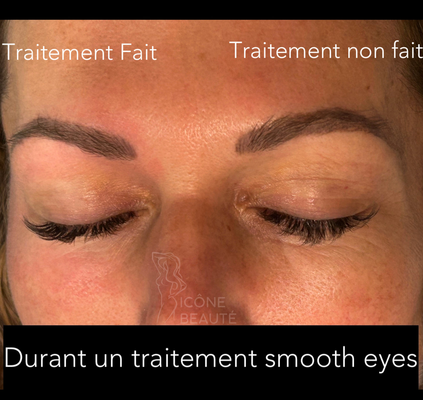 👁️ SmoothEye® – Rajeunissement du regard