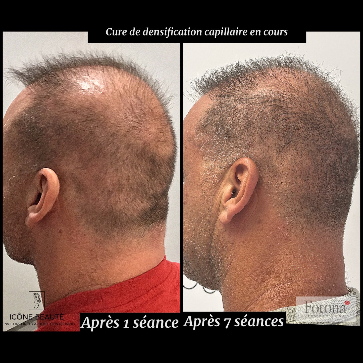 đč DENSIFICATION CAPILLAIRE - Laser Fotona - HairRestartÂź