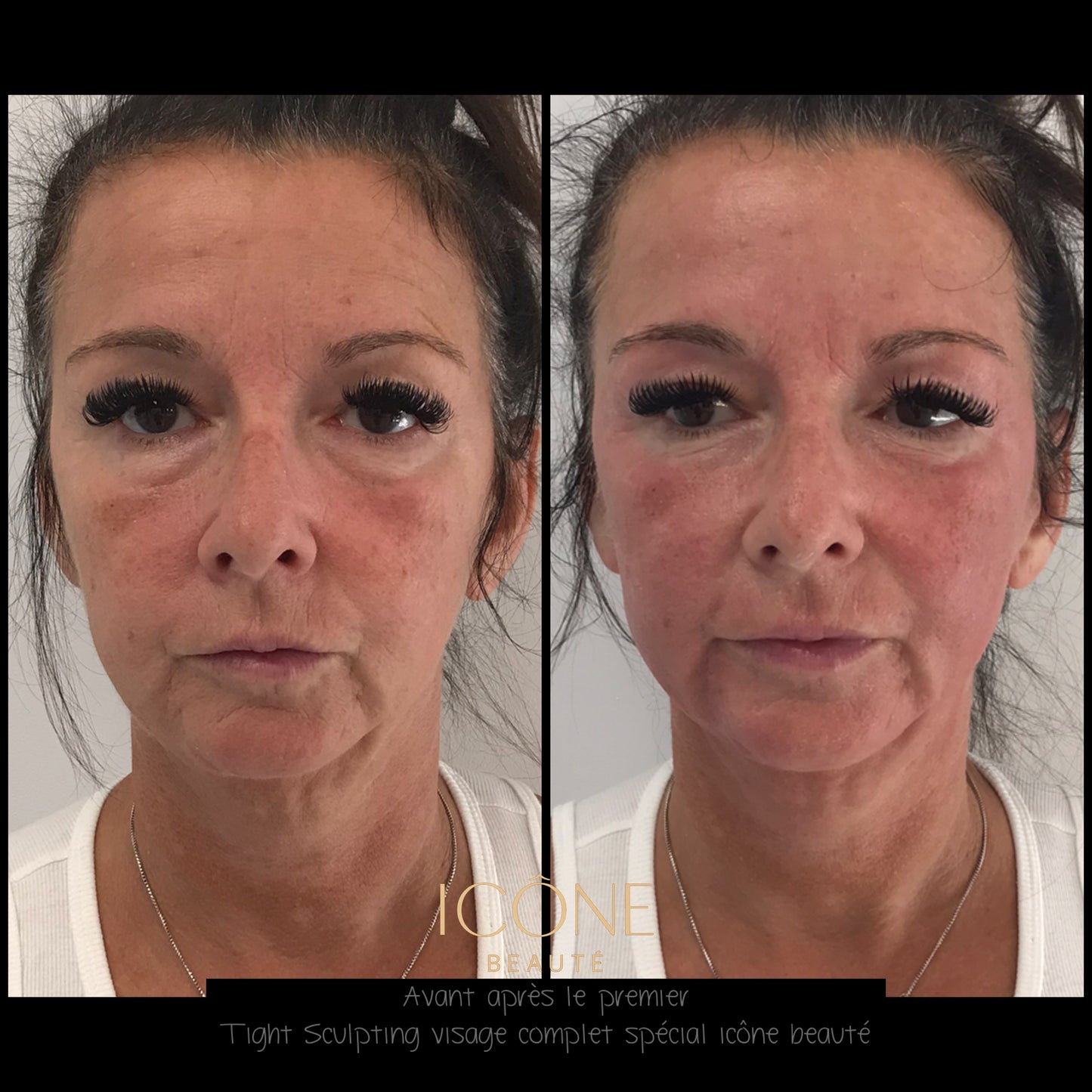 ✨ Skin Tightening Visage Complet – SIGNATURE Icône Beauté - Fotona