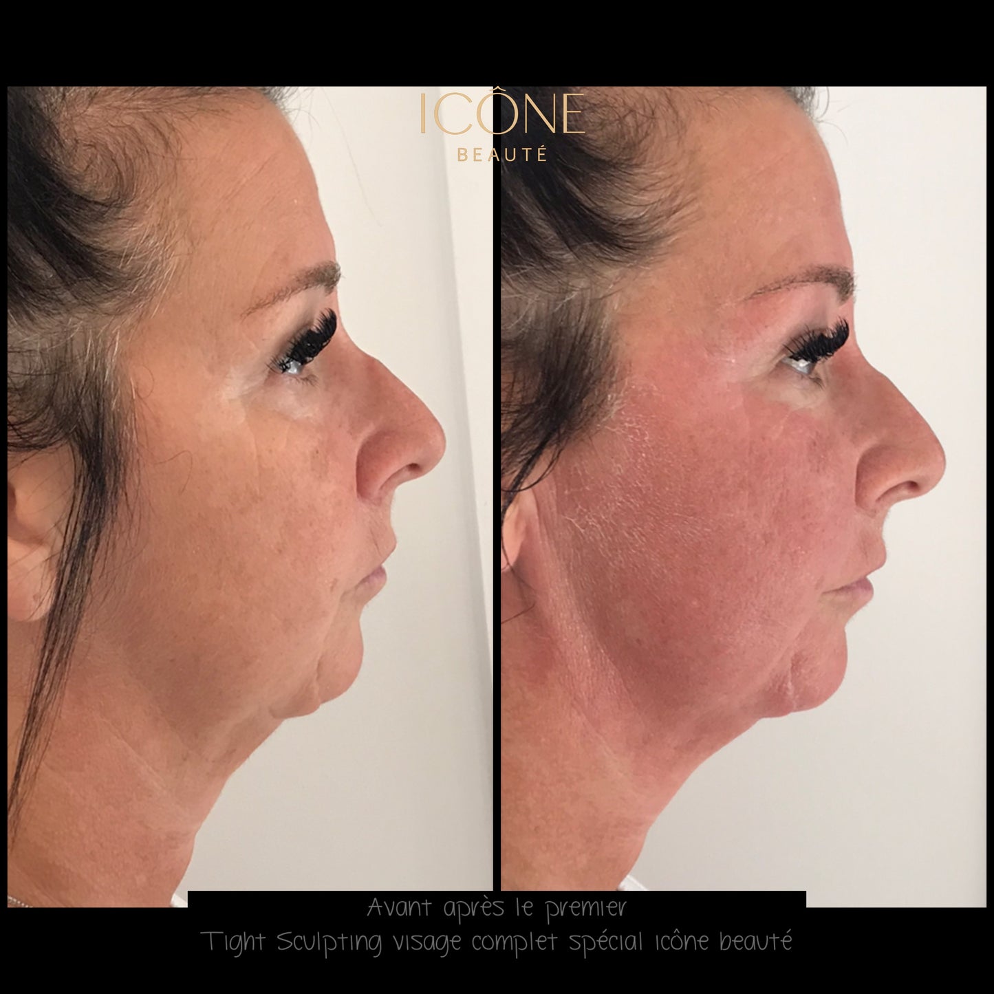 ✨ Skin Tightening Visage Complet – SIGNATURE Icône Beauté - Fotona