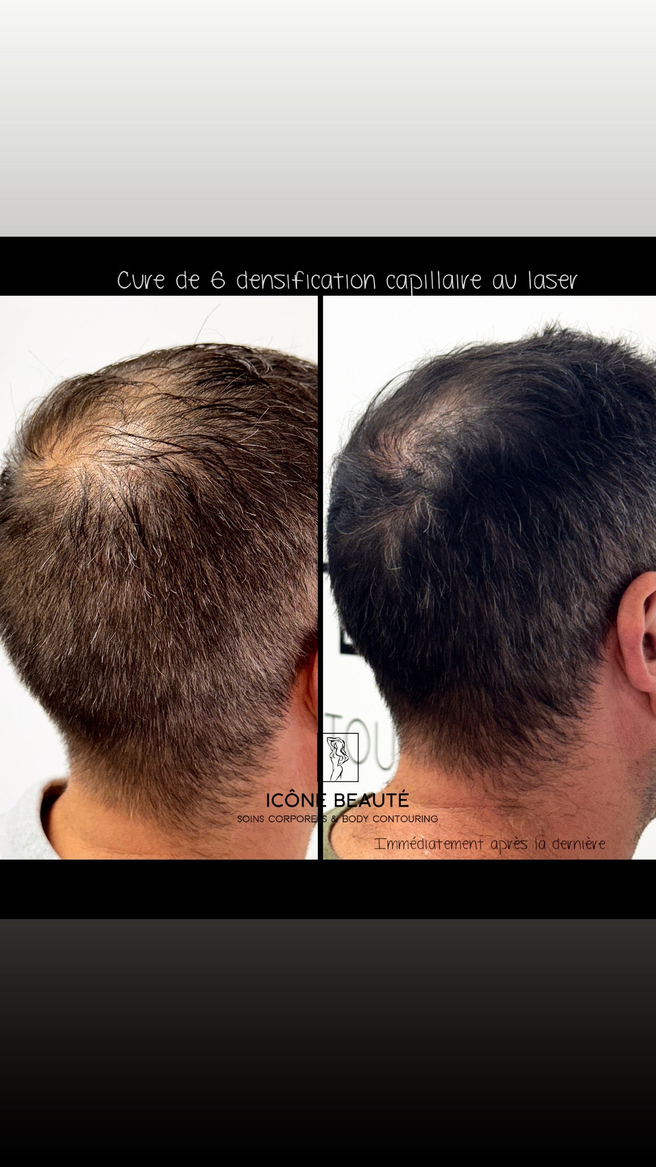 đč DENSIFICATION CAPILLAIRE - Laser Fotona - HairRestartÂź