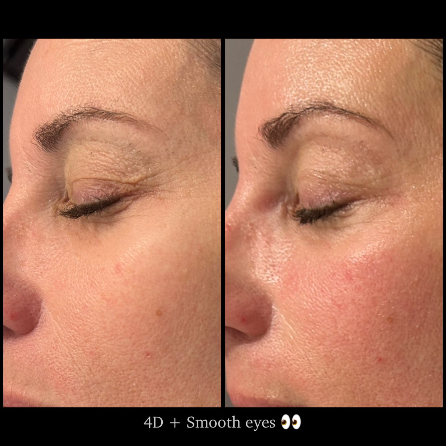 👁️ SmoothEye® – Rajeunissement du regard