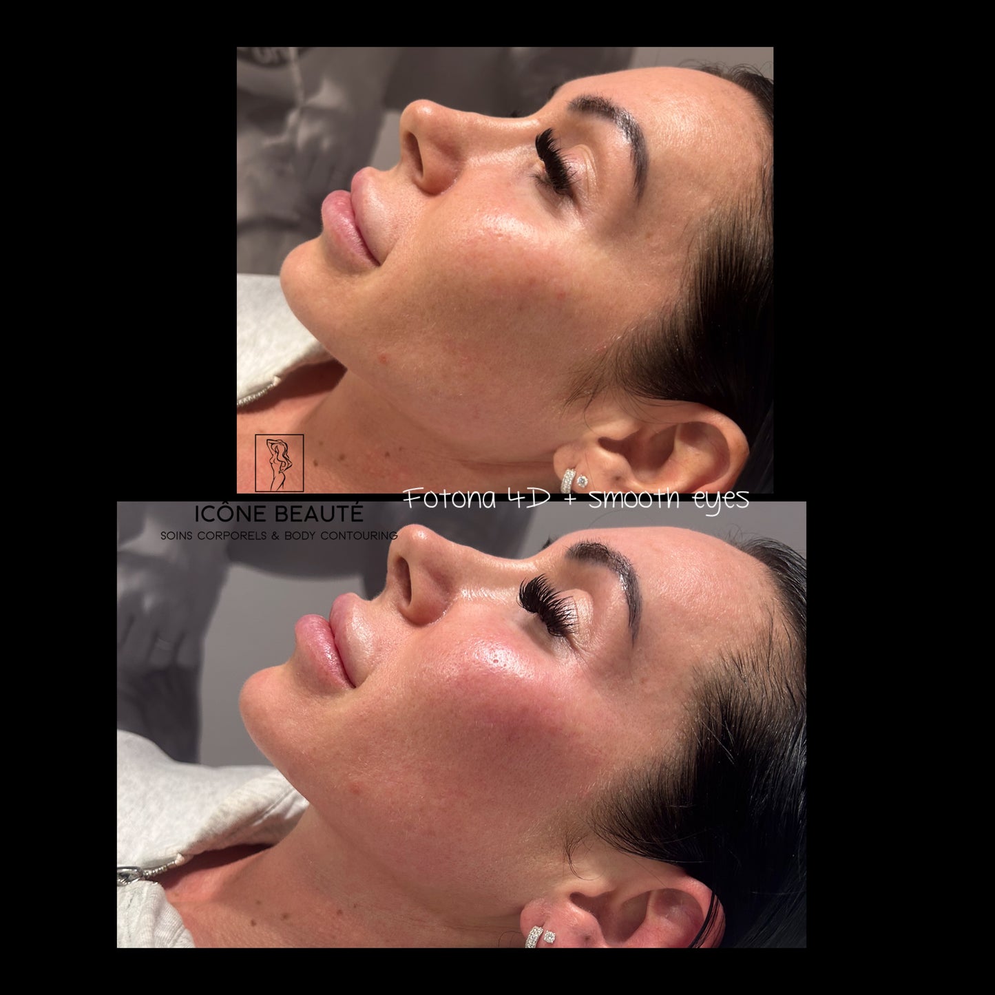 ✨ Skin Tightening Visage Complet – SIGNATURE Icône Beauté - Fotona
