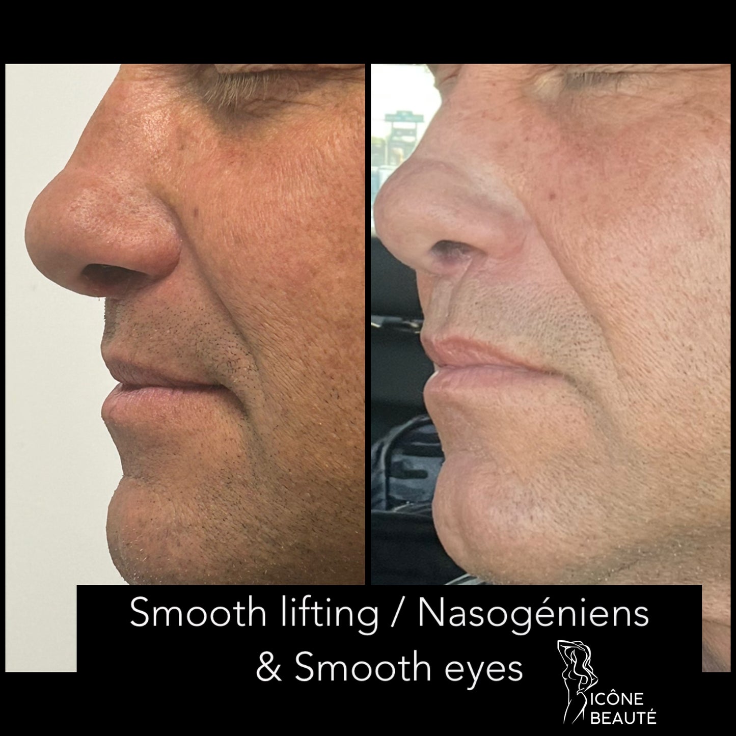 TightSculpting® – Lifting Bas du visage