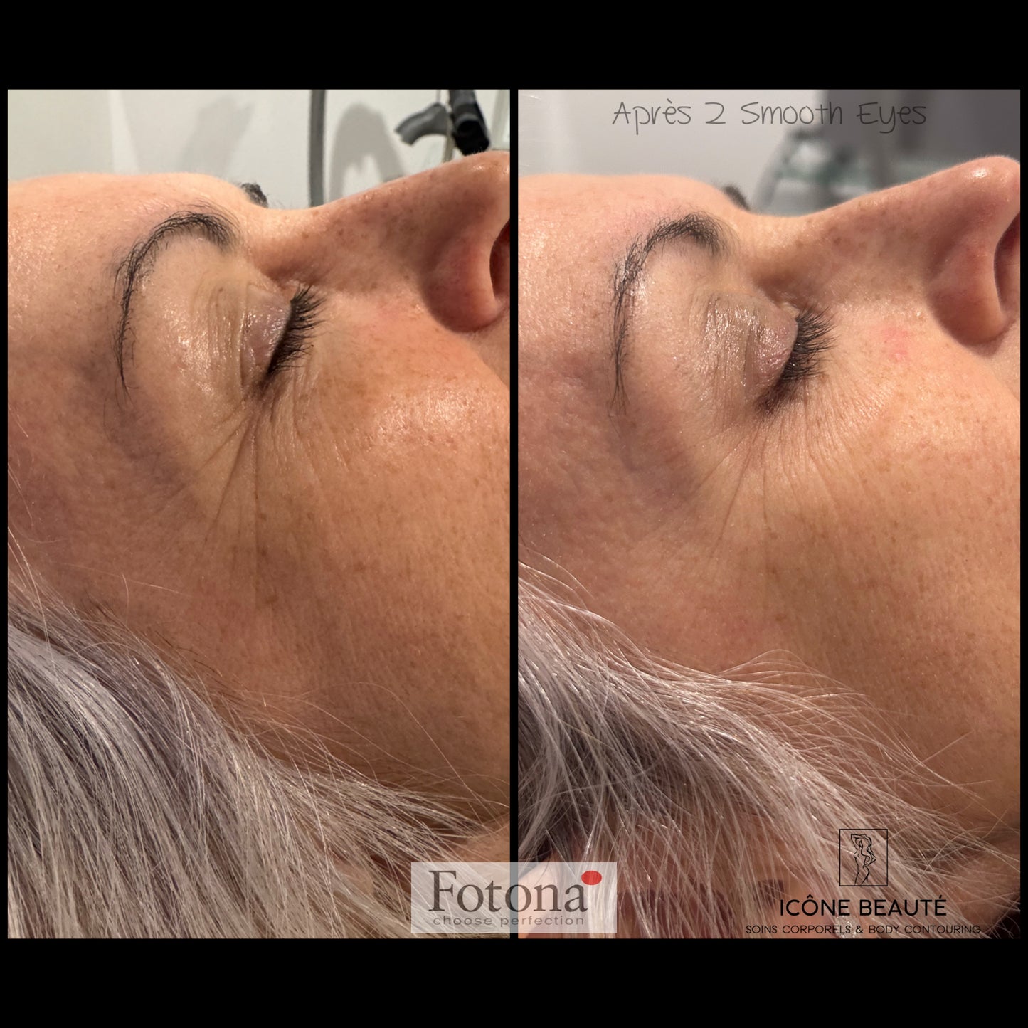 👁️ SmoothEye® – Rajeunissement du regard