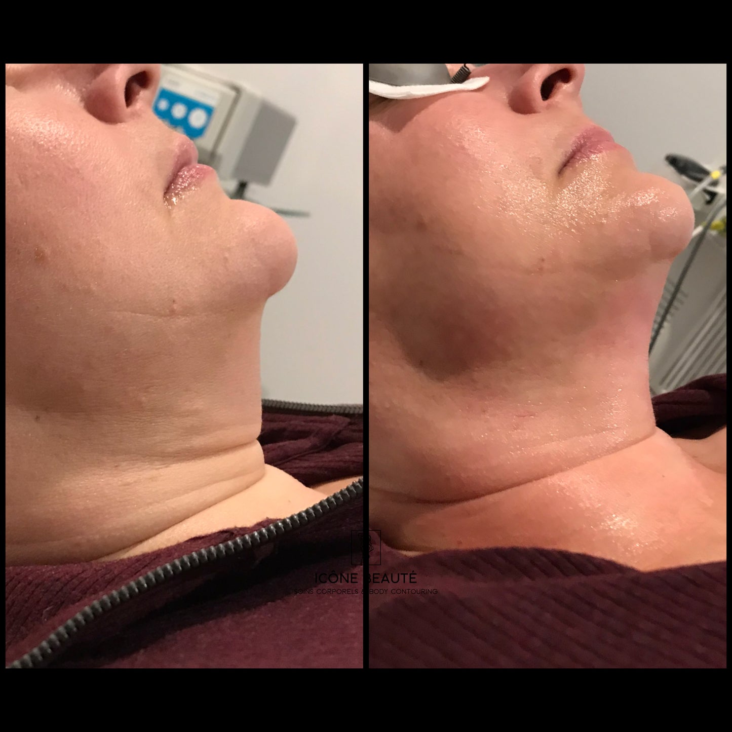 đ„ FOTONA LASER â Hot & Tight Sculpting (Menton / Cou)