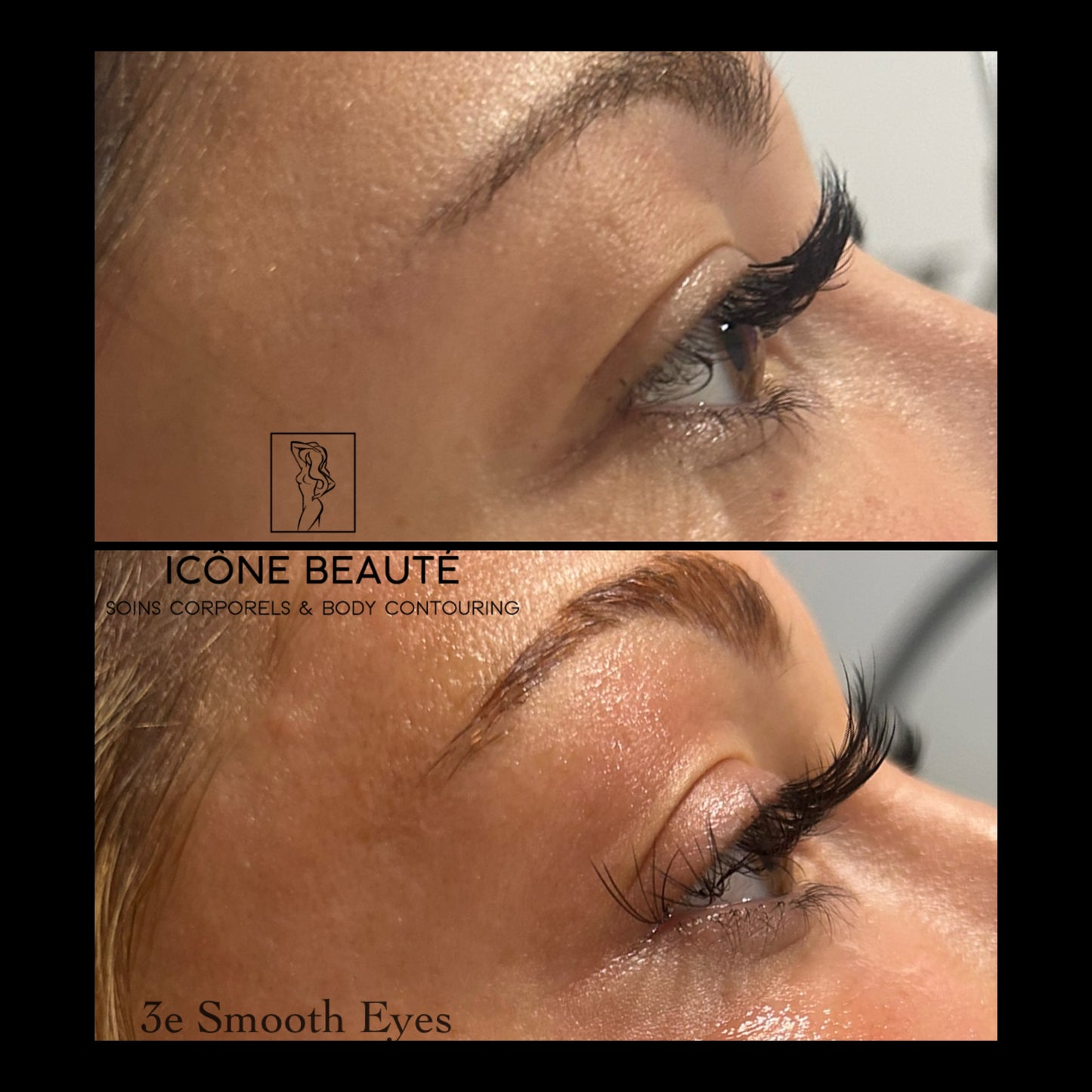 👁️ SmoothEye® – Rajeunissement du regard