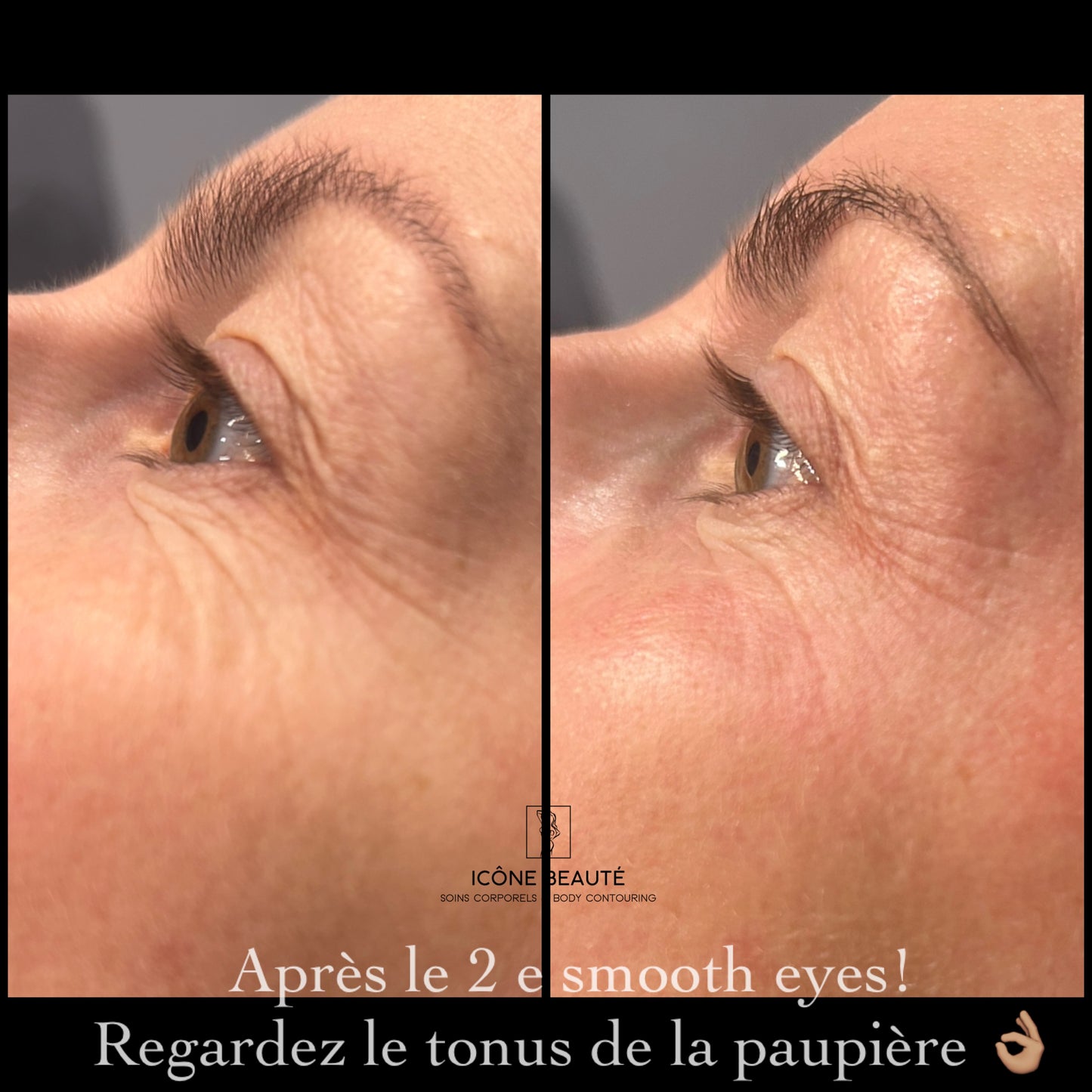 👁️ SmoothEye® – Rajeunissement du regard
