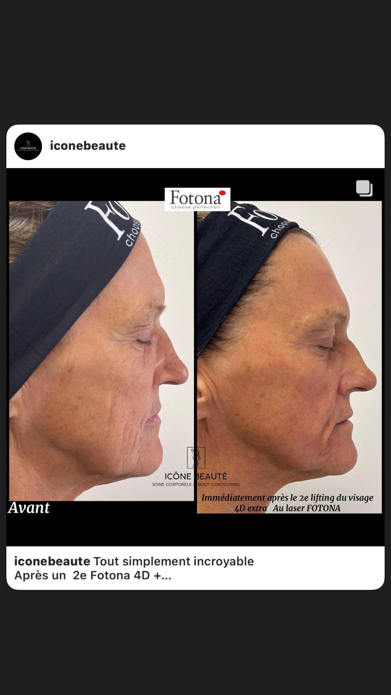 ✨ Skin Tightening Visage Complet – SIGNATURE Icône Beauté - Fotona