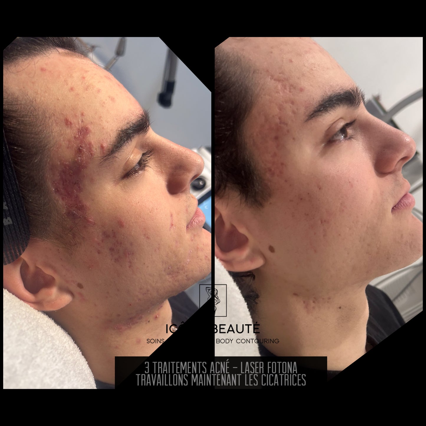 ✨ Traitement Laser FOTONA – Acné Active