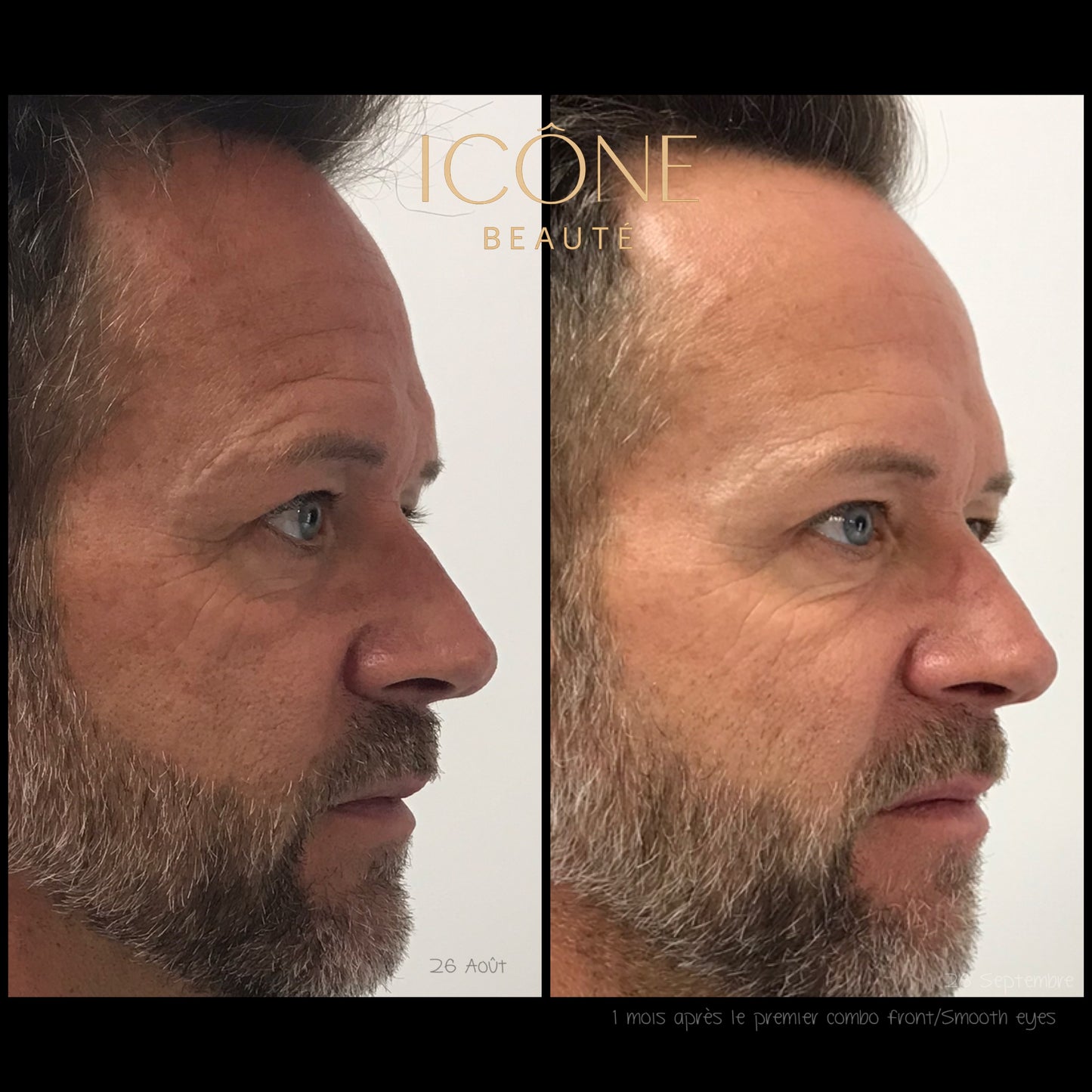 ✨ FOTONA LASER – Combo Smooth Eyes + Rides frontales