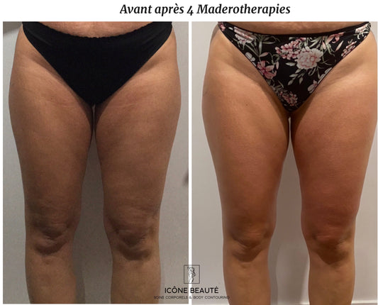 🔍 Comprendre les différents types de cellulite