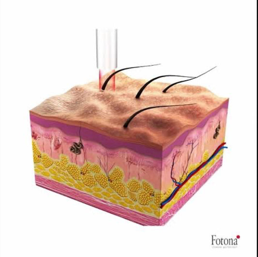 Q & A – Tout savoir sur l’épilation définitive au laser Fotona