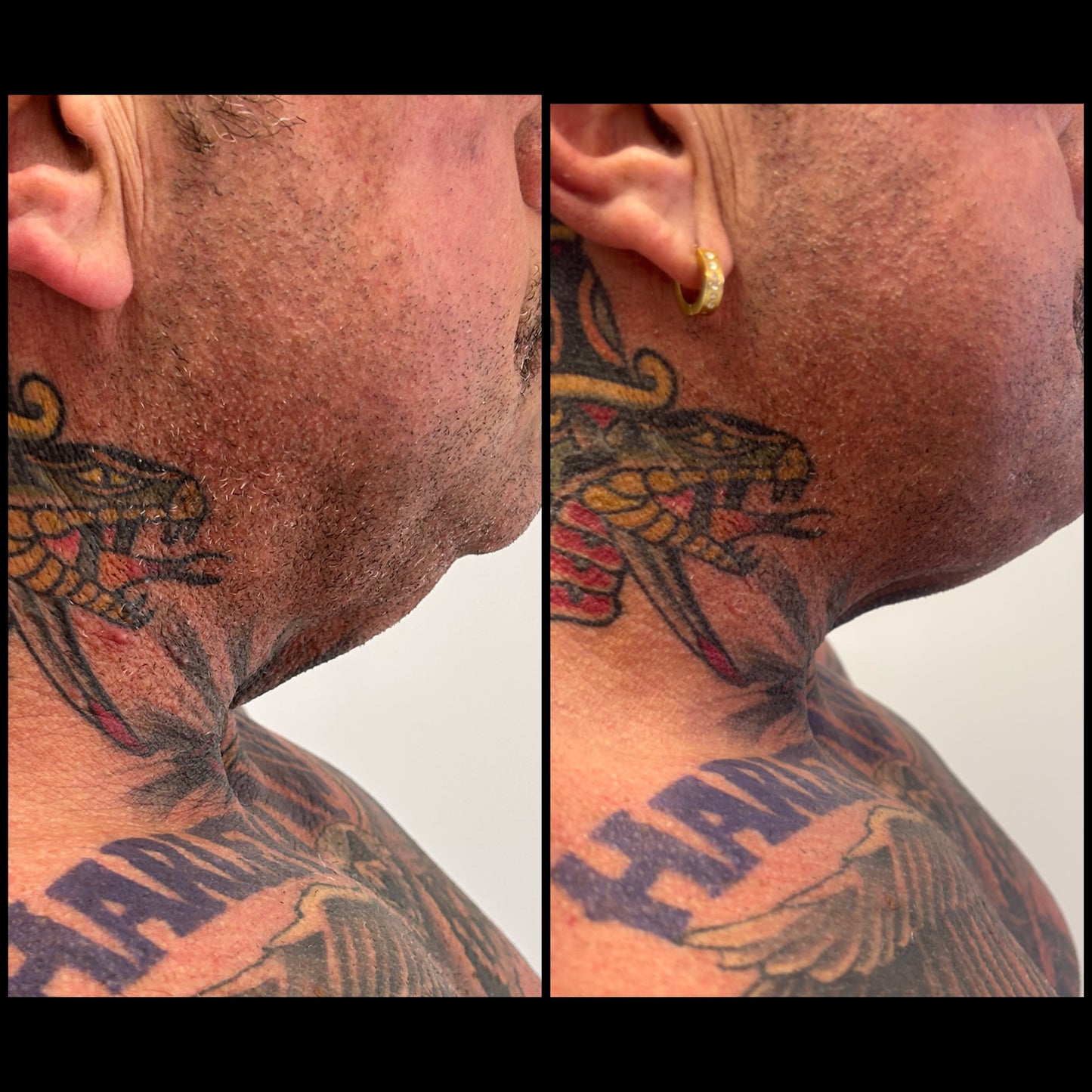 🔥 FOTONA LASER – Hot & Tight Sculpting (Menton / Cou)