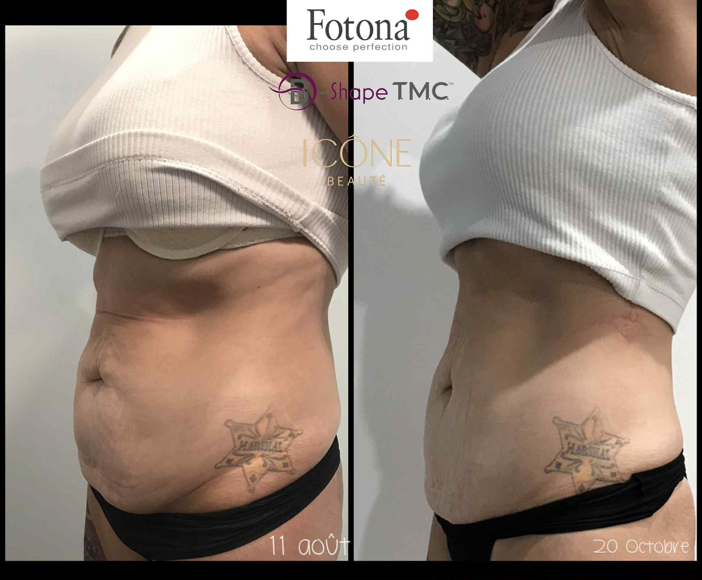 🔥 Hot & Tight Sculpting – Remodelage par Laser Fotona