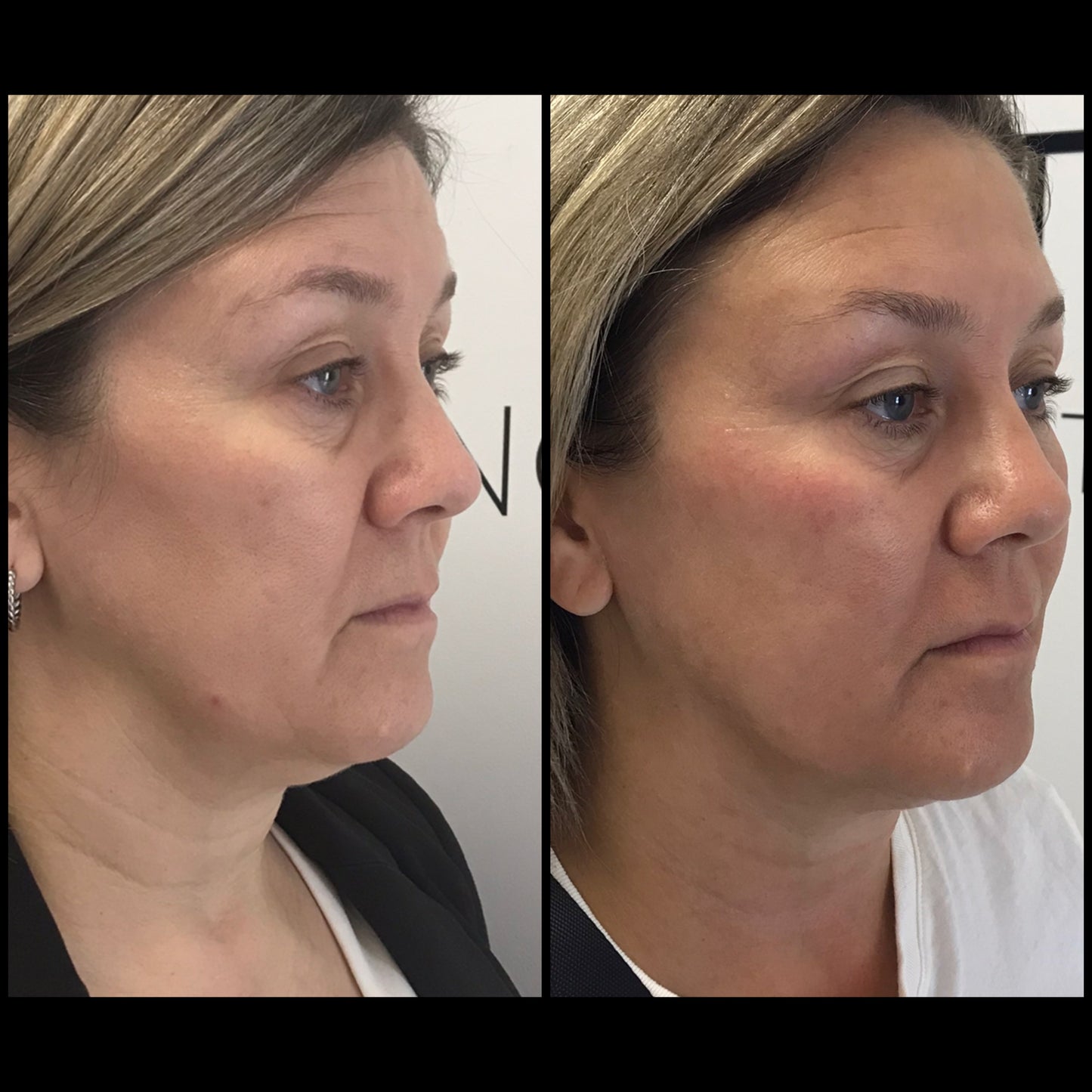 🔥 FOTONA LASER – Hot & Tight Sculpting (Menton / Cou)
