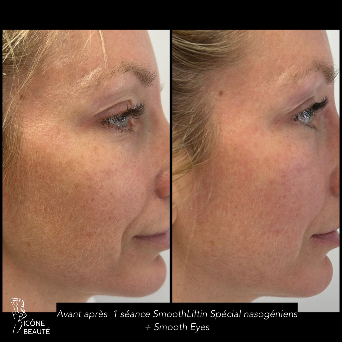 TightSculpting® –  Lifting Bas du visage