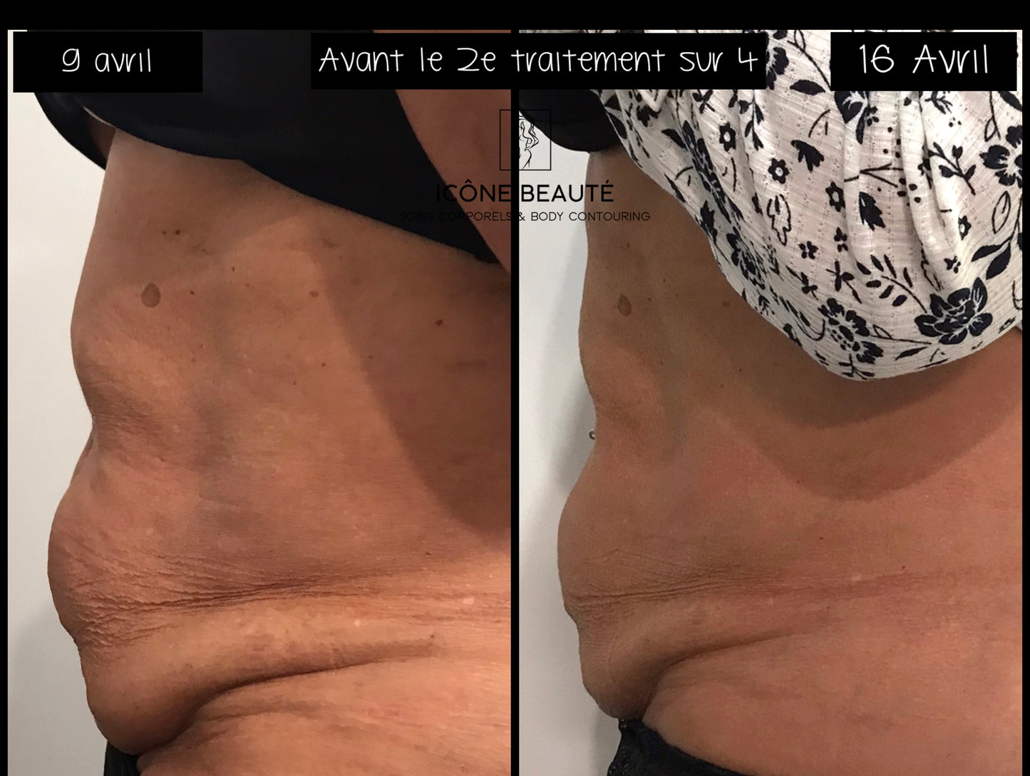 🔥 Cure Hot & Tight EXPRESS – Fonte Adipeuse & Skin Tightening Corps
