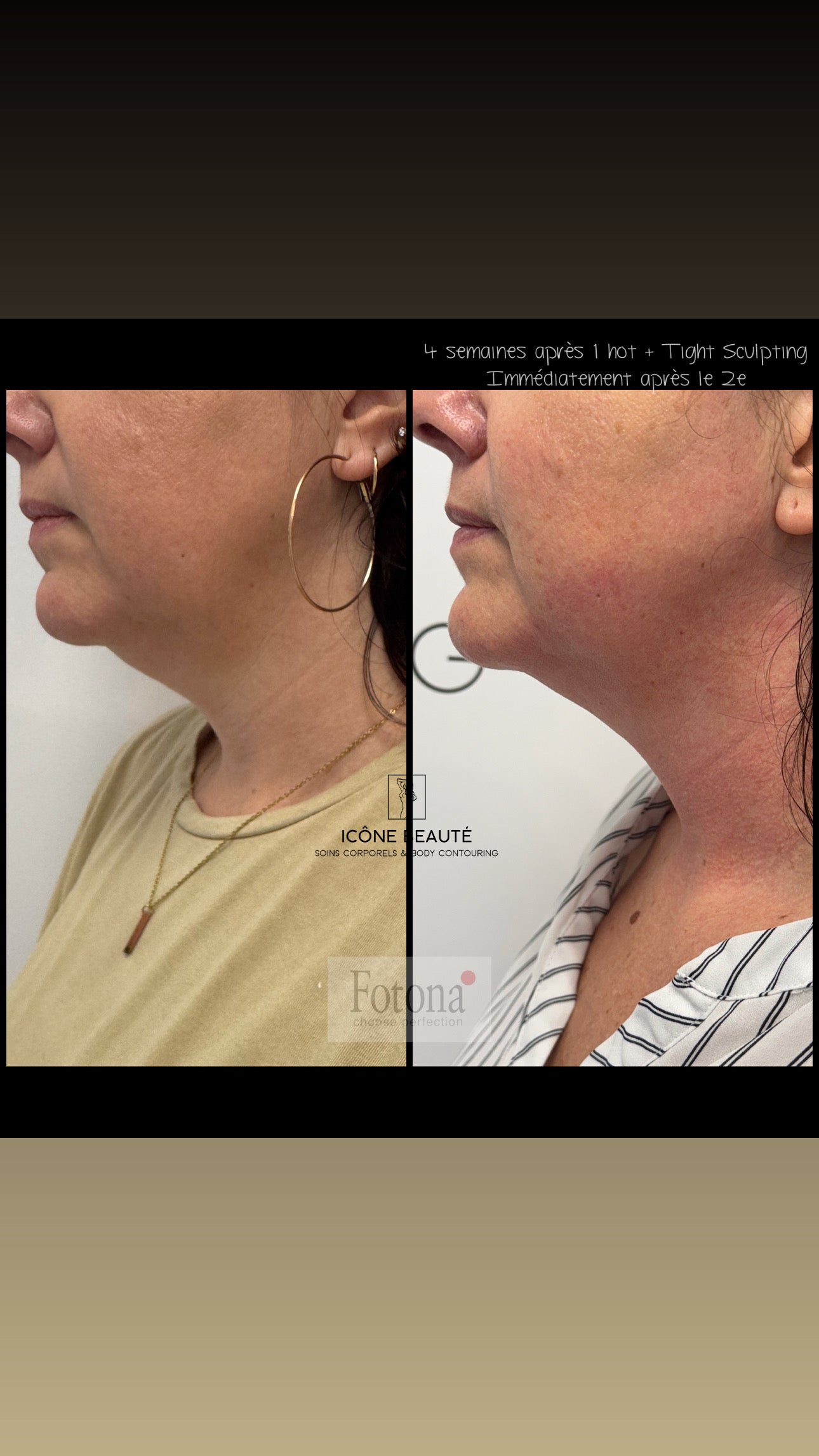 🔥 FOTONA LASER – Hot & Tight Sculpting (Menton / Cou)