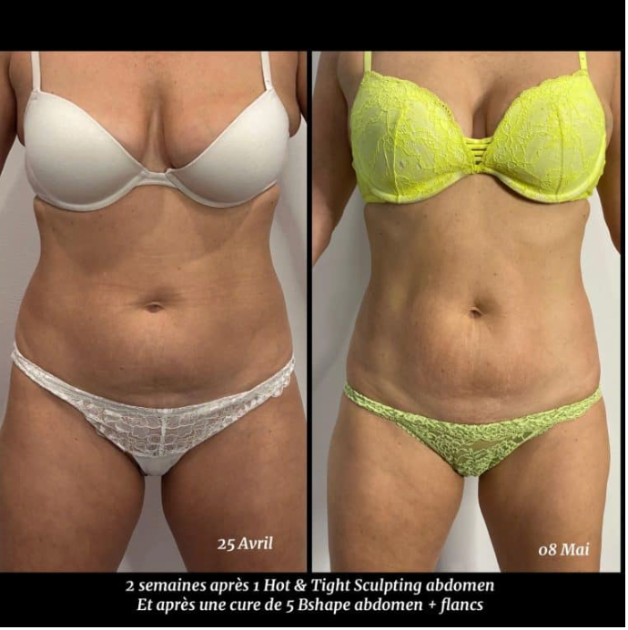 🔥 Hot & Tight Sculpting – Remodelage par Laser Fotona - CORPS