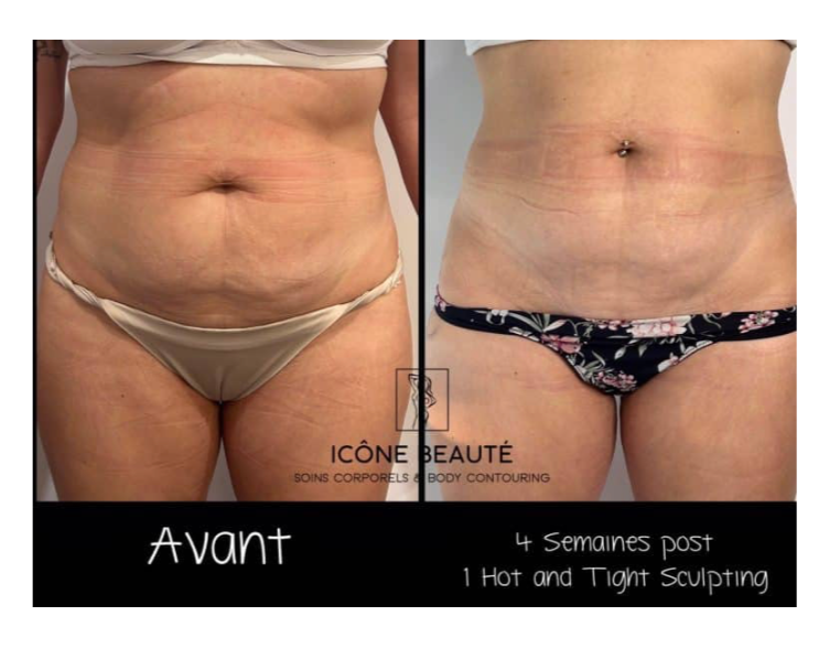 🔥 Hot & Tight Sculpting – Remodelage par Laser Fotona - CORPS