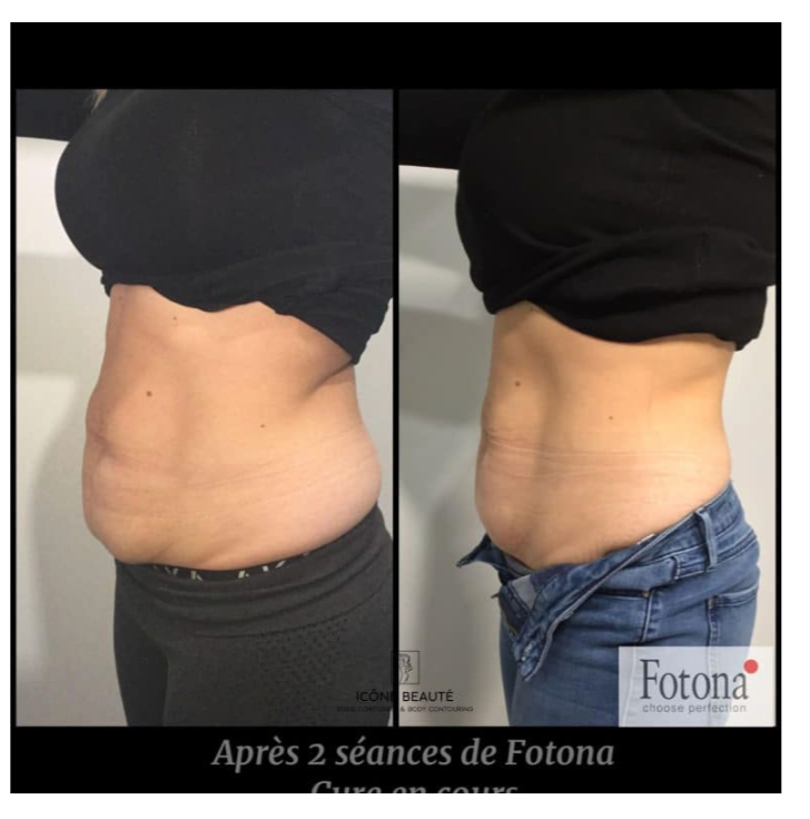 🔥 Hot & Tight Sculpting – Remodelage par Laser Fotona - CORPS