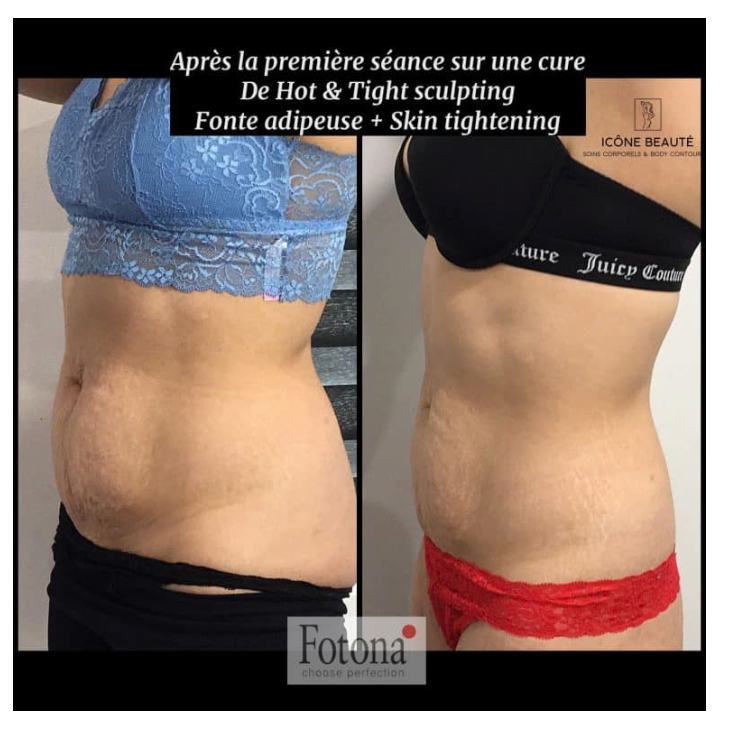 🔥 Hot & Tight Sculpting – Remodelage par Laser Fotona - CORPS