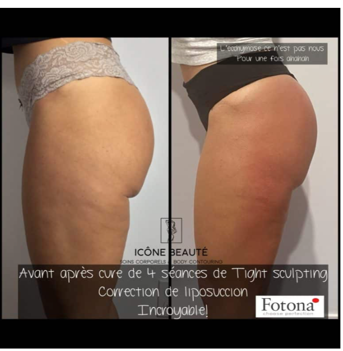 🔥 Hot & Tight Sculpting – Remodelage par Laser Fotona - CORPS