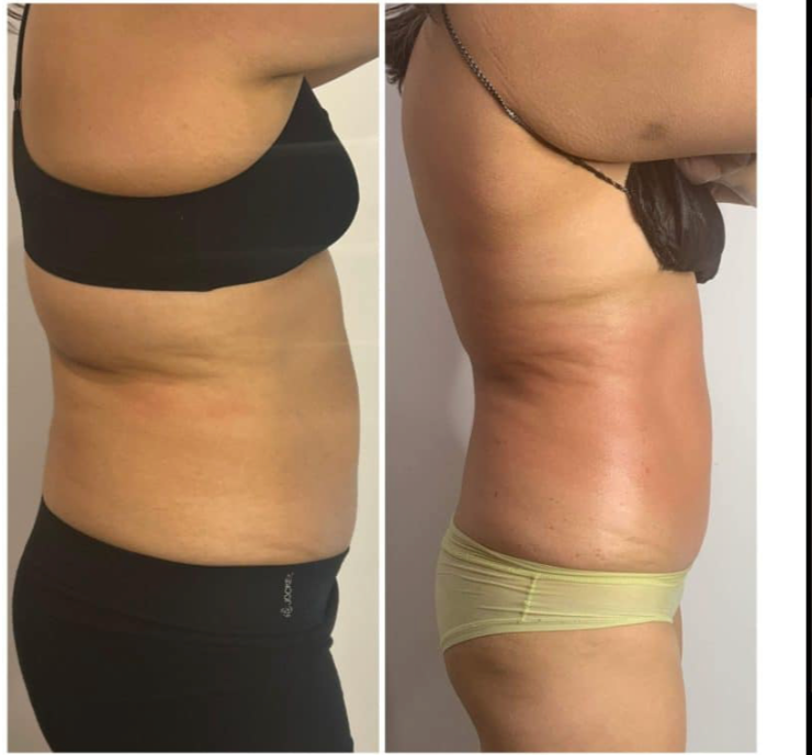 🔥 Hot & Tight Sculpting – Remodelage par Laser Fotona - CORPS