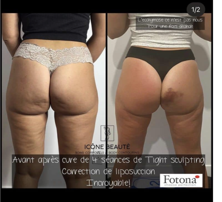 🔥 Hot & Tight Sculpting – Remodelage par Laser Fotona - CORPS