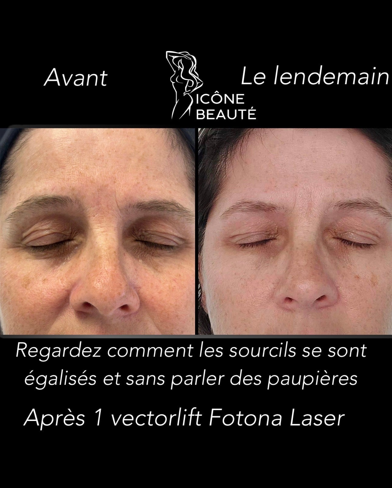 👁️ FOTONA - Vector Lift (paupières)