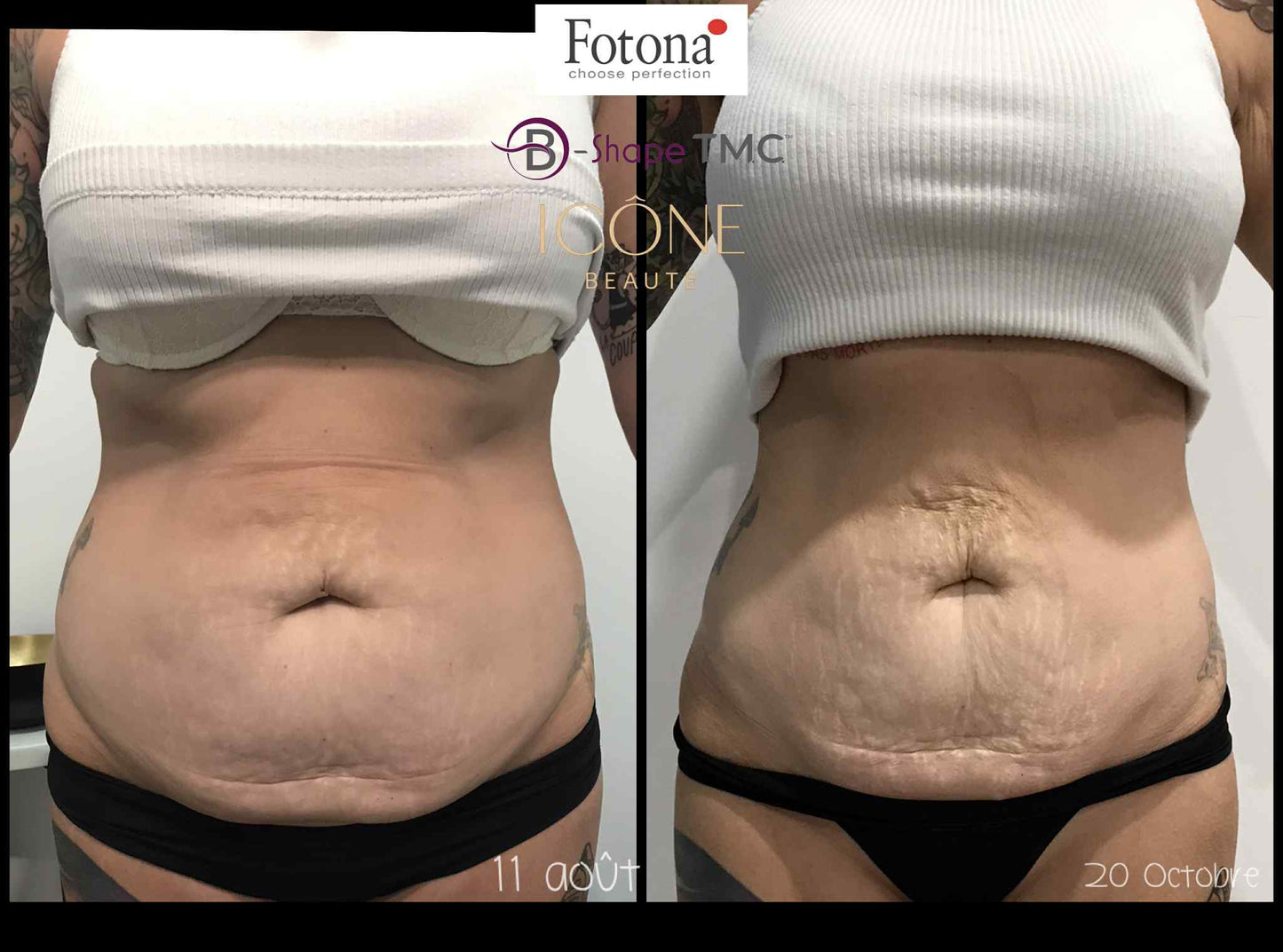 🔥 Hot & Tight Sculpting – Remodelage par Laser Fotona
